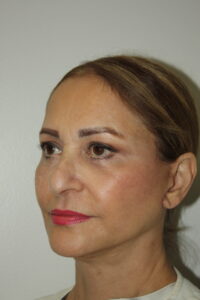 Female Facelift Patient 69 - After - 1 Thumbnail