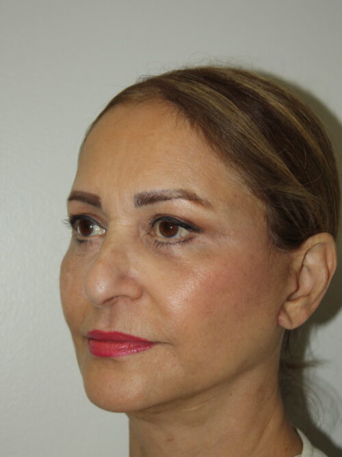 Female Facelift Patient 69 - After - 1