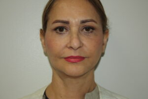 Female Facelift Patient 69 - After - 2 Thumbnail