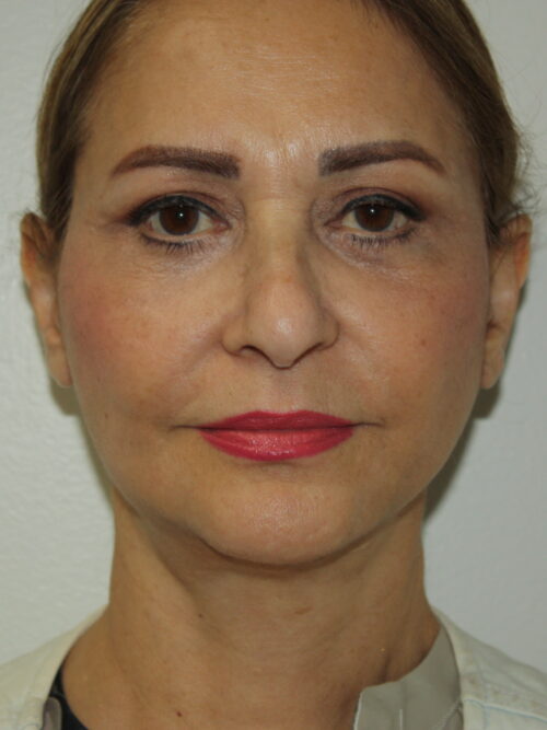 Female Facelift Patient 69 - After - 2