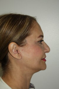 Female Facelift Patient 69 - After - 3 Thumbnail