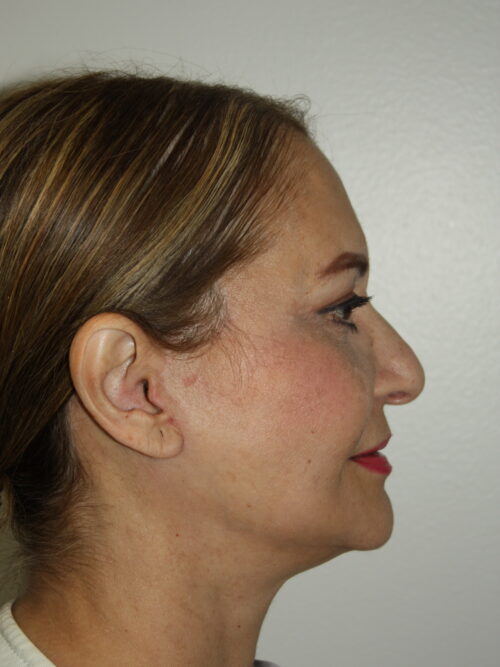 Female Facelift Patient 69 - After - 3